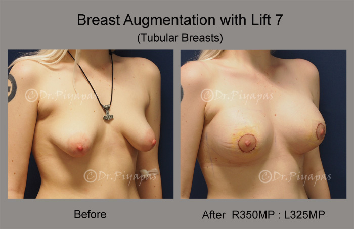 breast-augmentation-with-lift-16