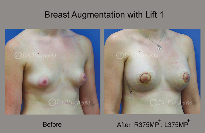 breast-augmentation-with-lift-4