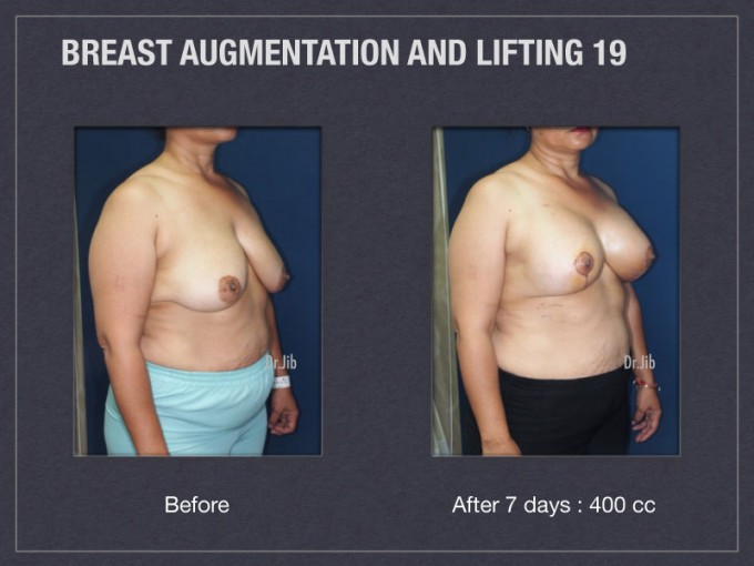 https://www.restoredbeautygetaways.com/wp-content/uploads/2014/03/breast-augmentation-lift-38-680x510.jpg